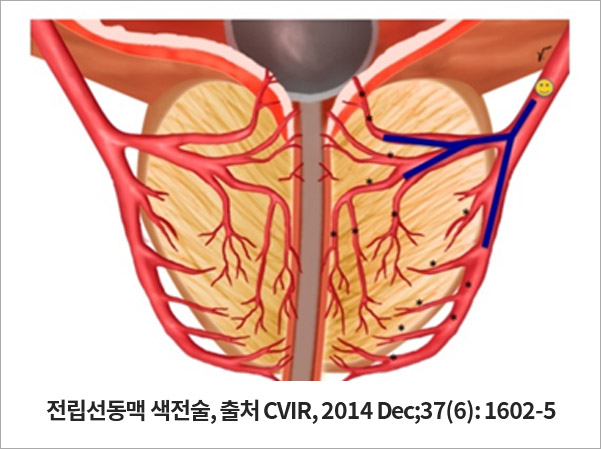 전립선동맥 색전술, 출처 CVIR, 2014 Dec;37(6): 1602-5